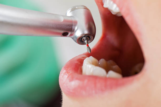 Best Emergency Wisdom Teeth Removal in Meadowlakes, TX
